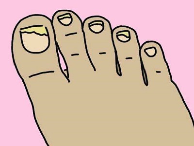 指甲银屑病与灰指甲的区别